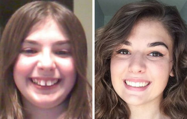 Then And Now: People Fix Their Smiles (23 pics)
