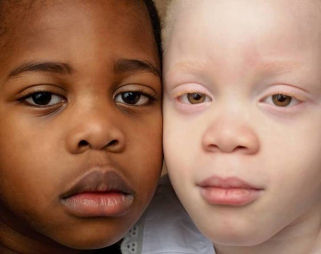 Twins With Different Skin Colors (15 pics)