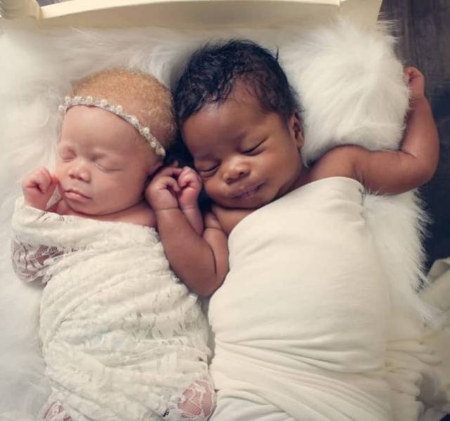 Twins With Different Skin Colors (15 pics)