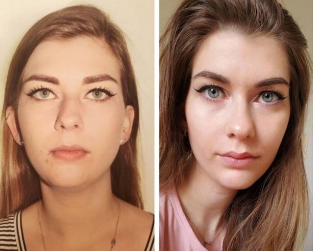 People Show Their Changes After Plastic Surgeries (20 pics)