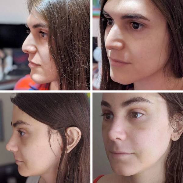 People Show Their Changes After Plastic Surgeries (20 pics)