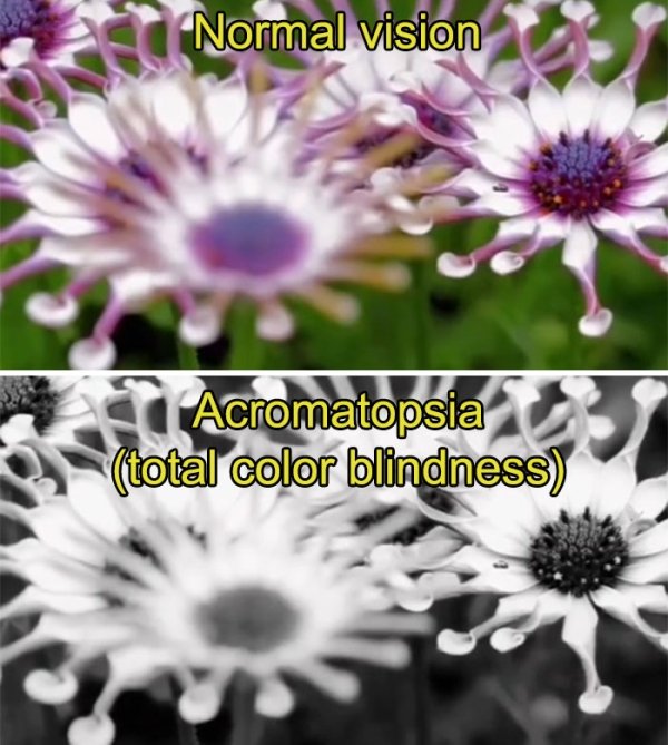 How People See With Different Medical Conditions (23 pics)