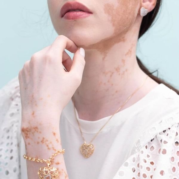 Girl With Vitiligo Show Her Beauty Through Modeling (19 pics)