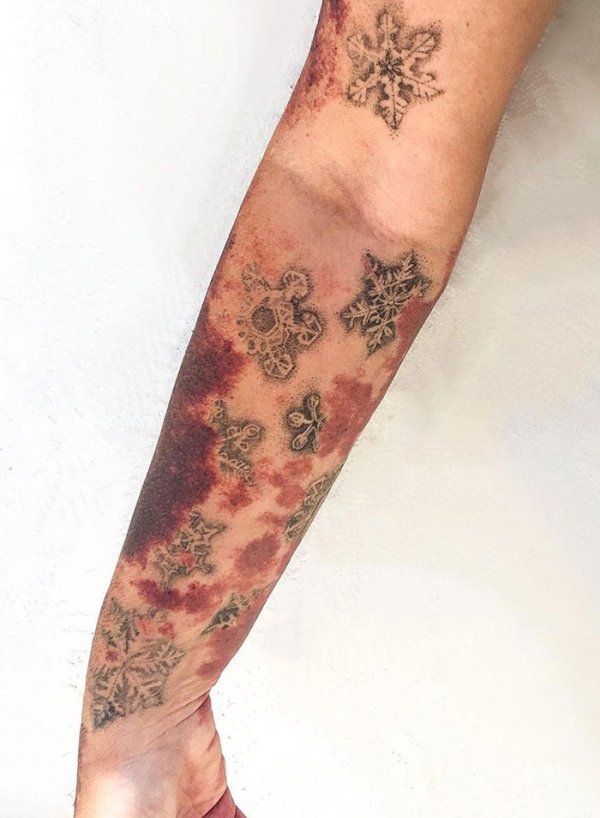 Creative Tattoos That Cover Scars (32 pics)