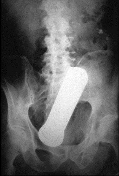 Weird Objects On X-Rays (27 pics) Weird Objects On X-Rays (27 pics)