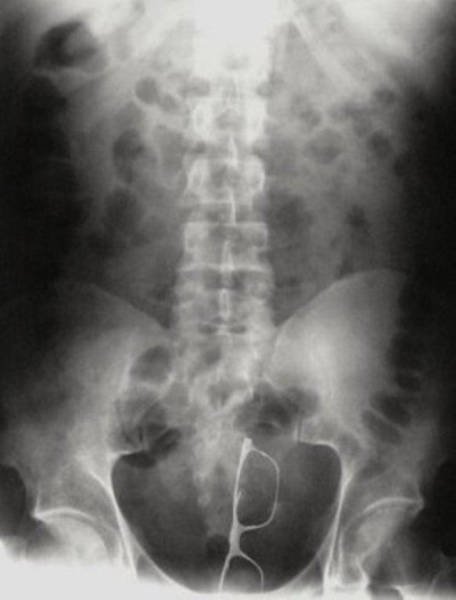 Weird Objects On X-Rays (27 pics)
