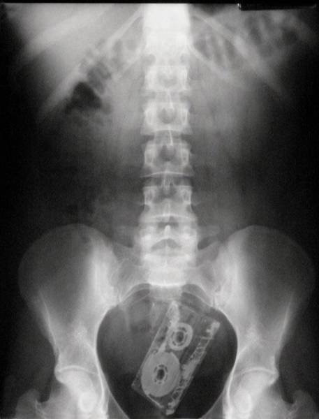 Weird Objects On X-Rays (27 pics) Weird Objects On X-Rays (27 pics)