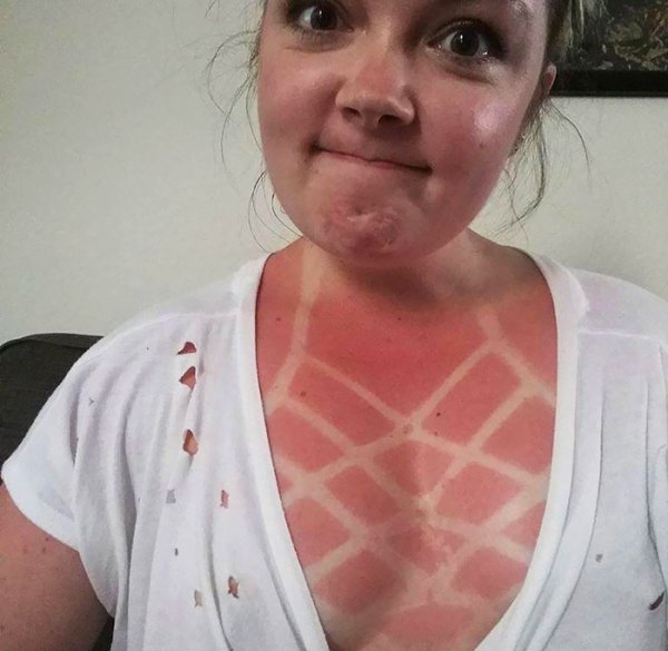 Funny Sunburns (28 pics)