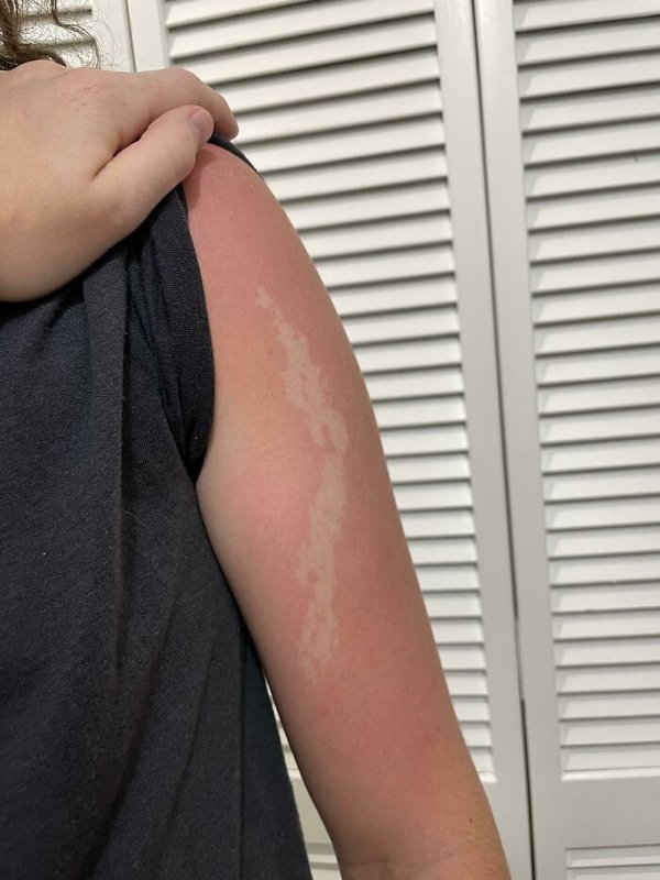 Unusual And Painful Sunburns (28 pics)