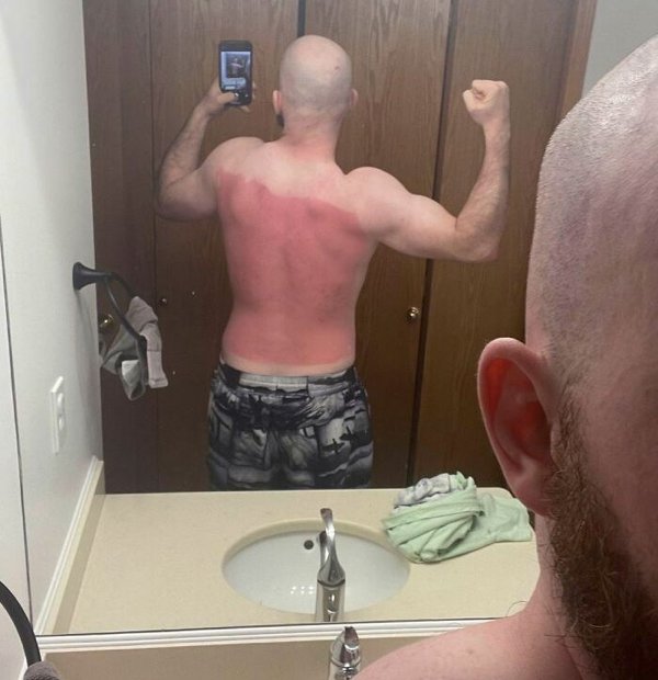 Unusual And Painful Sunburns (28 pics)