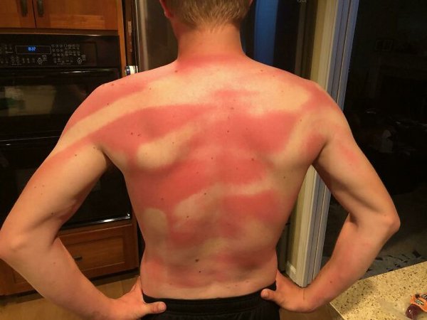 Unusual And Painful Sunburns (28 pics)