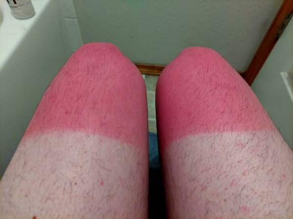 Unusual And Painful Sunburns (28 pics)