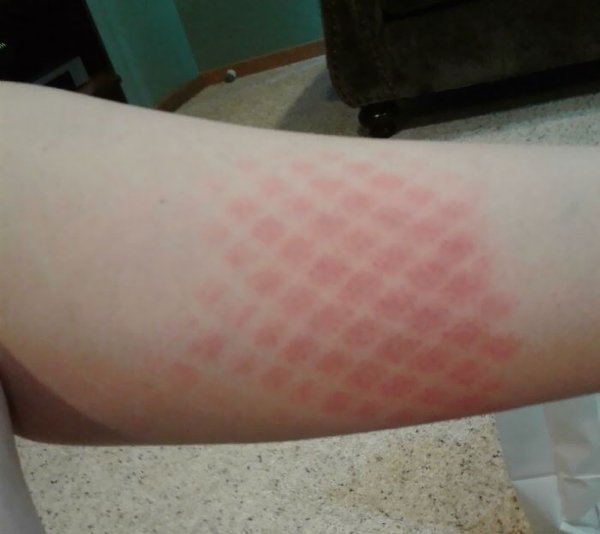 Unusual And Painful Sunburns (28 pics)