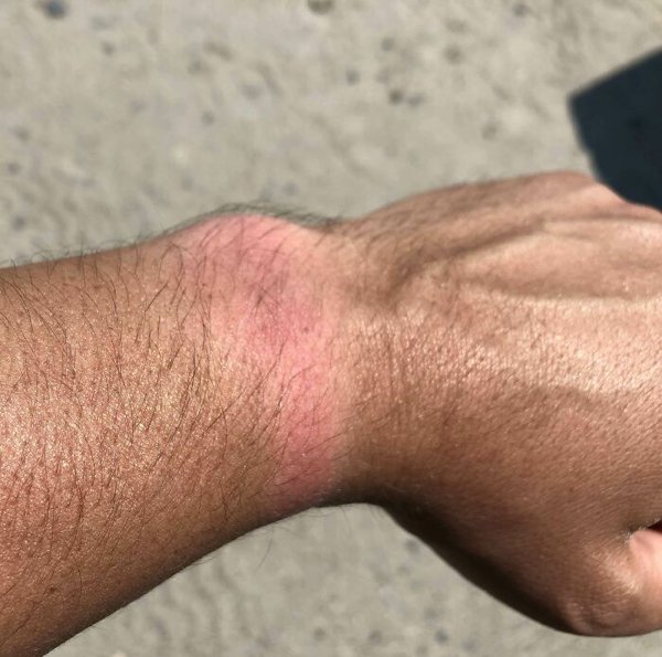 Unusual And Painful Sunburns (28 pics)