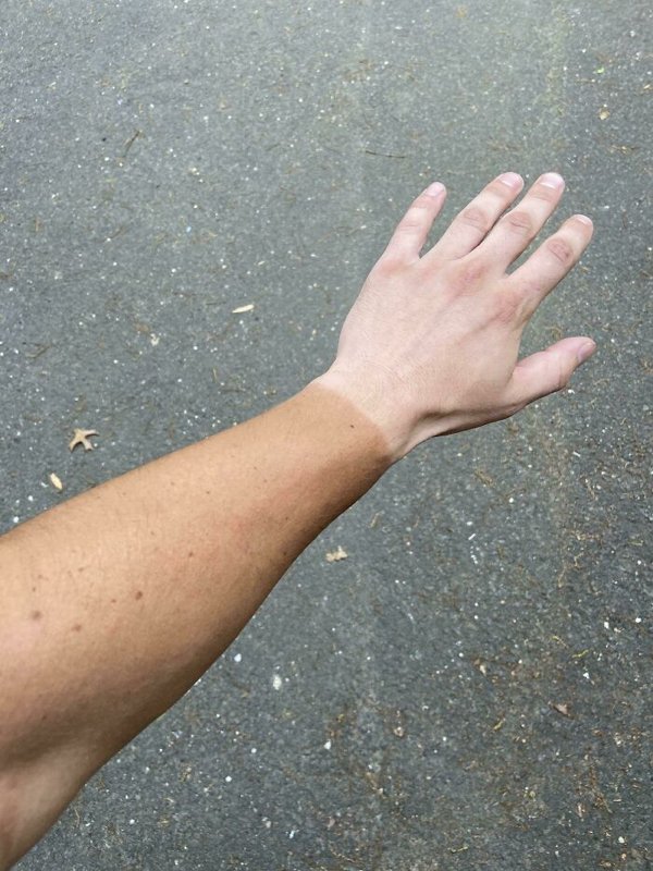 Unusual And Painful Sunburns (28 pics)