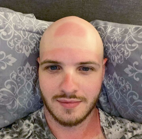 Unusual And Painful Sunburns (28 pics)