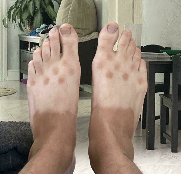 Unusual And Painful Sunburns (28 pics)