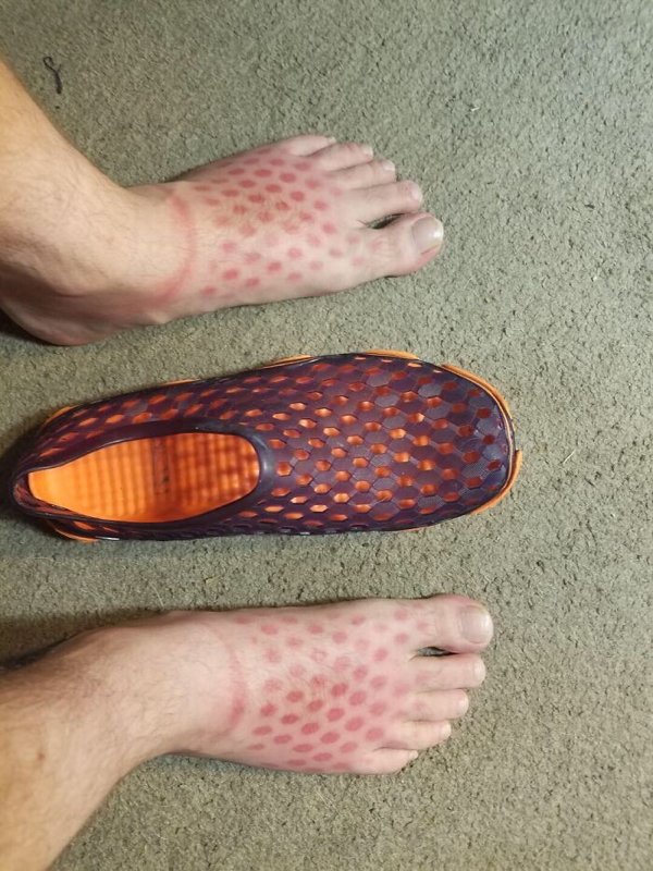Unusual And Painful Sunburns (28 pics)