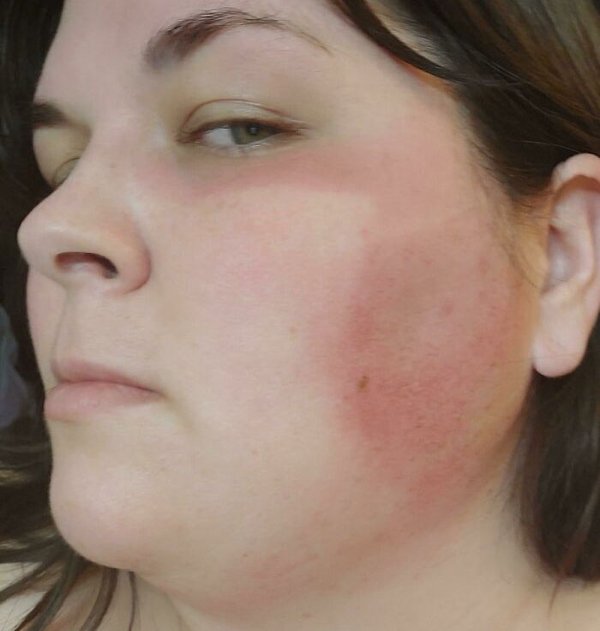 Unusual And Painful Sunburns (28 pics)