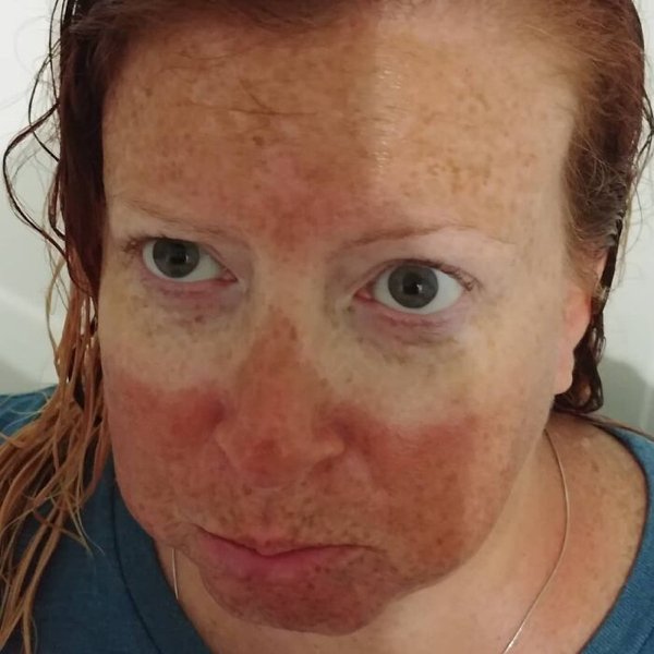 Unusual And Painful Sunburns (28 pics)