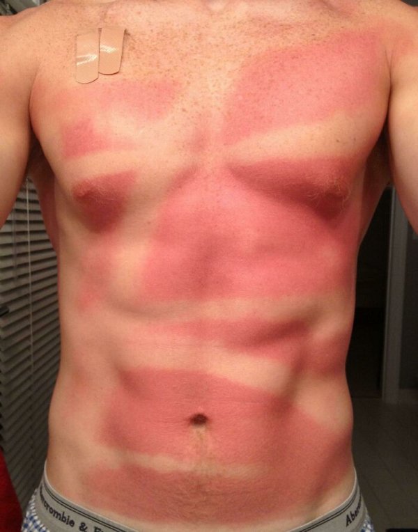 Unusual And Painful Sunburns (28 pics)