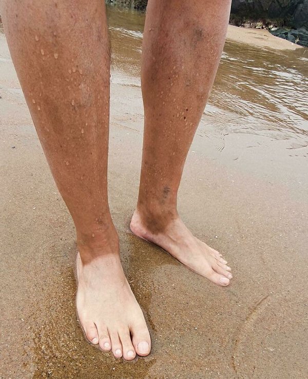 Unusual And Painful Sunburns (28 pics)