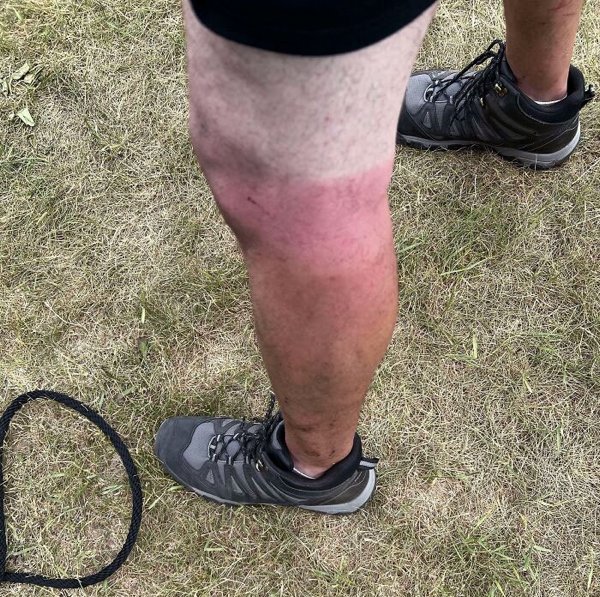 Unusual And Painful Sunburns (28 pics)