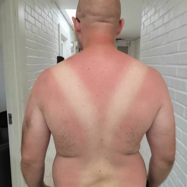 Unusual And Painful Sunburns (28 pics)