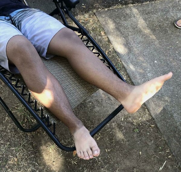 Unusual And Painful Sunburns (28 pics)