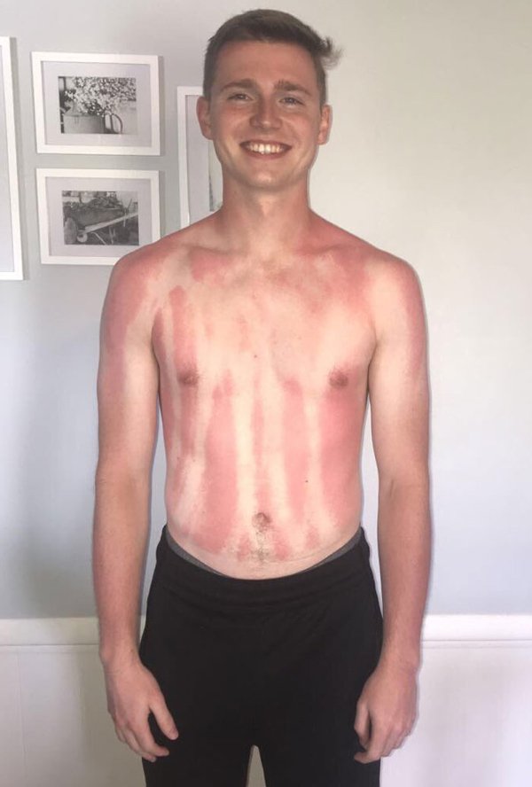 Unusual And Painful Sunburns (28 pics)