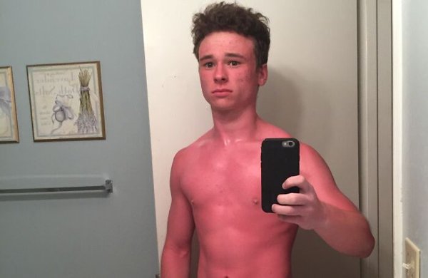 Unusual And Painful Sunburns (28 pics)