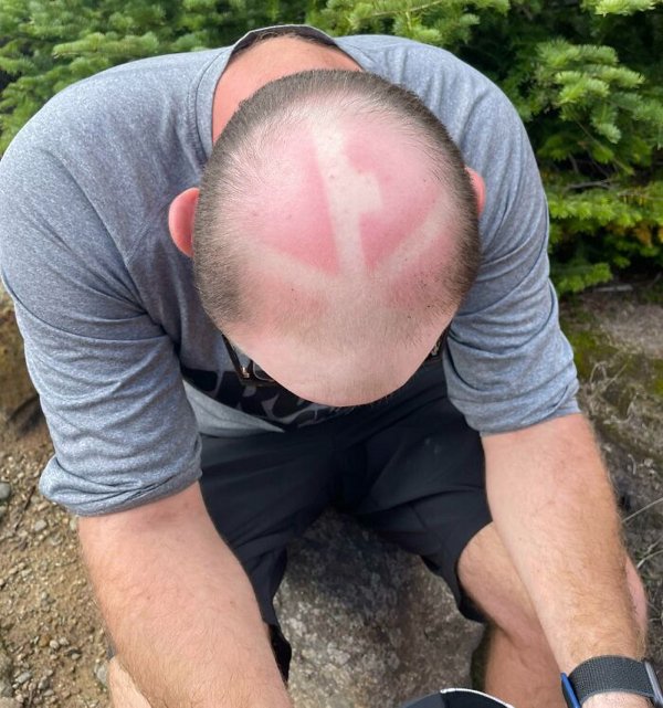 Unusual And Painful Sunburns (28 pics)