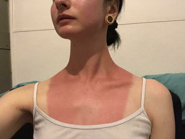 Unusual And Painful Sunburns (28 pics)