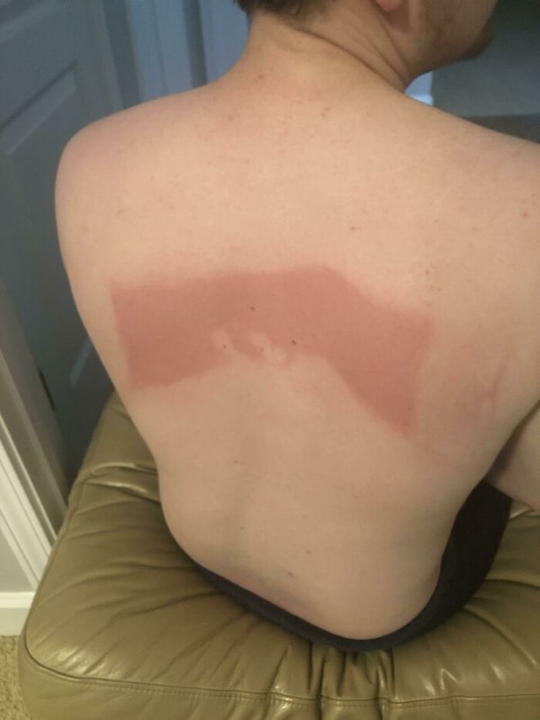 Unusual And Painful Sunburns (28 pics)