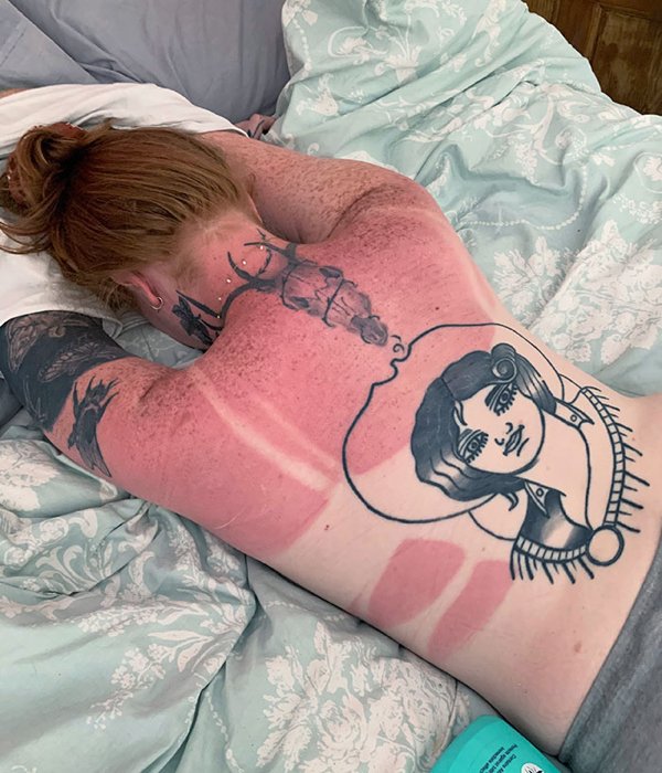 Unusual And Painful Sunburns (28 pics)