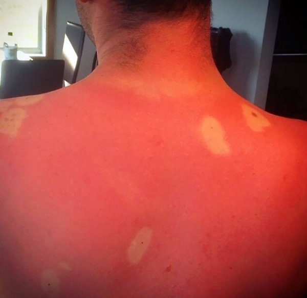 Unusual And Painful Sunburns (28 pics)