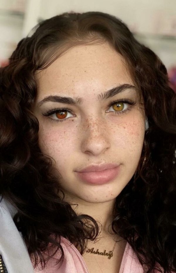 People With Unusual Genetic Anomalies (30 pics)