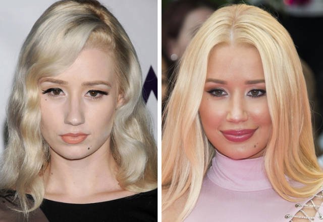 Celebrities Before And After Plastic Surgery (10 pics)