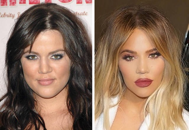Celebrities Before And After Plastic Surgery (10 pics)