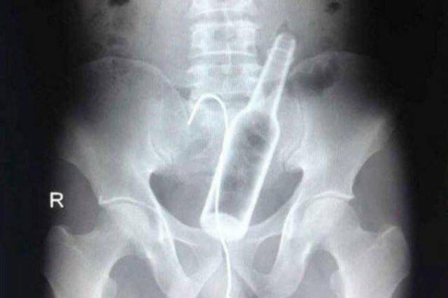 Weird Objects On X-Rays (27 pics)
