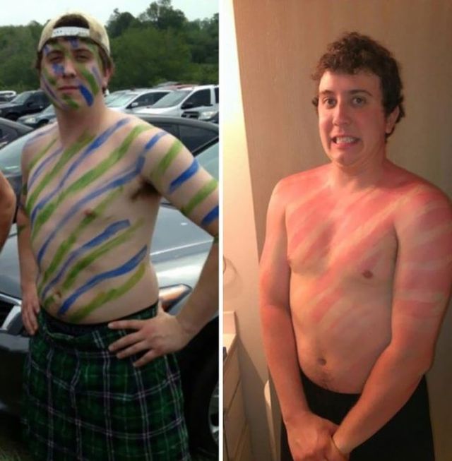 Funny Sunburns (28 pics)