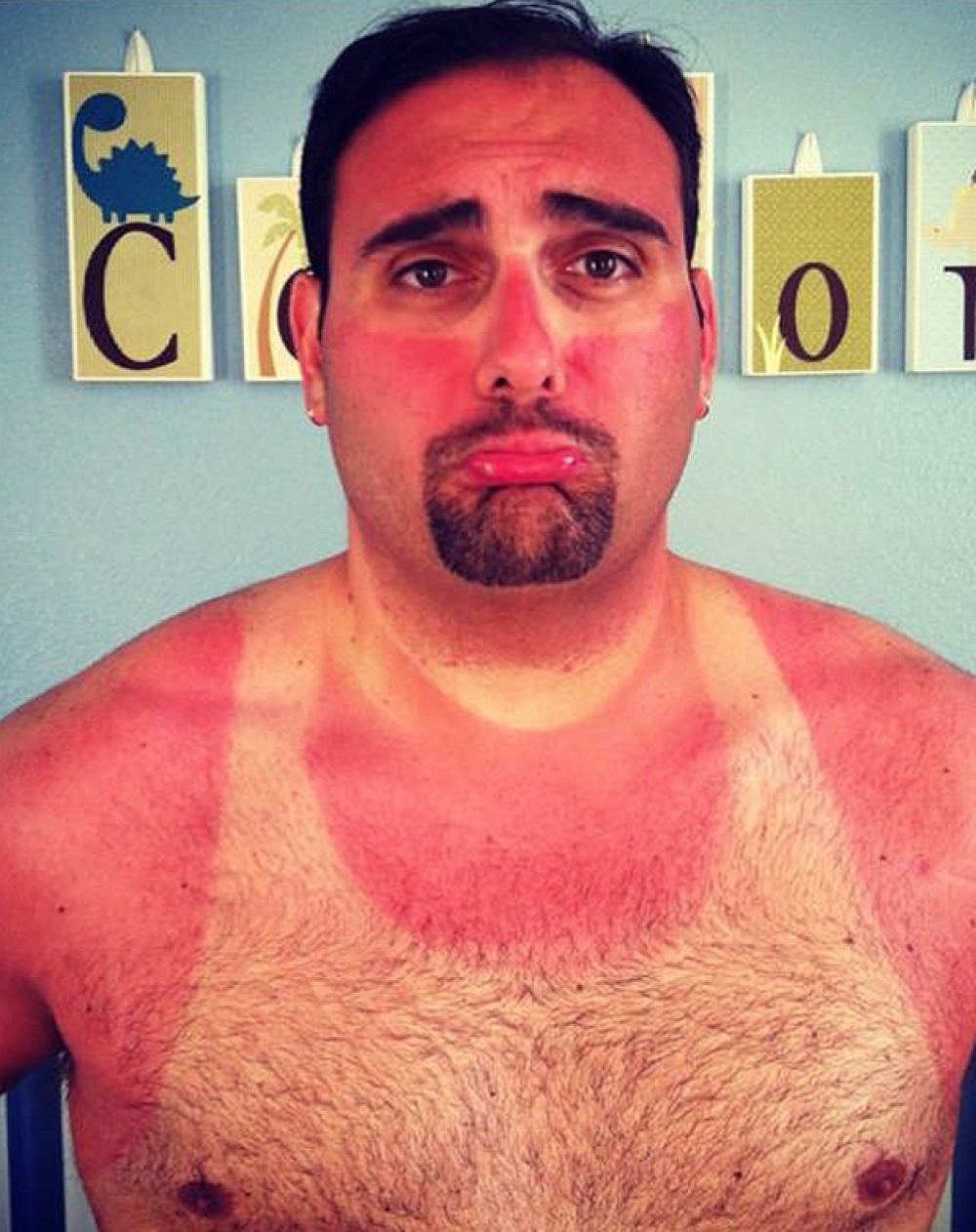 weird-and-funny-sunburns-18-pics