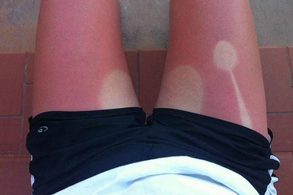 Weird And Funny Sunburns (18 pics)