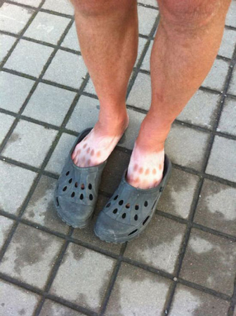 Weird And Funny Sunburns (18 pics)