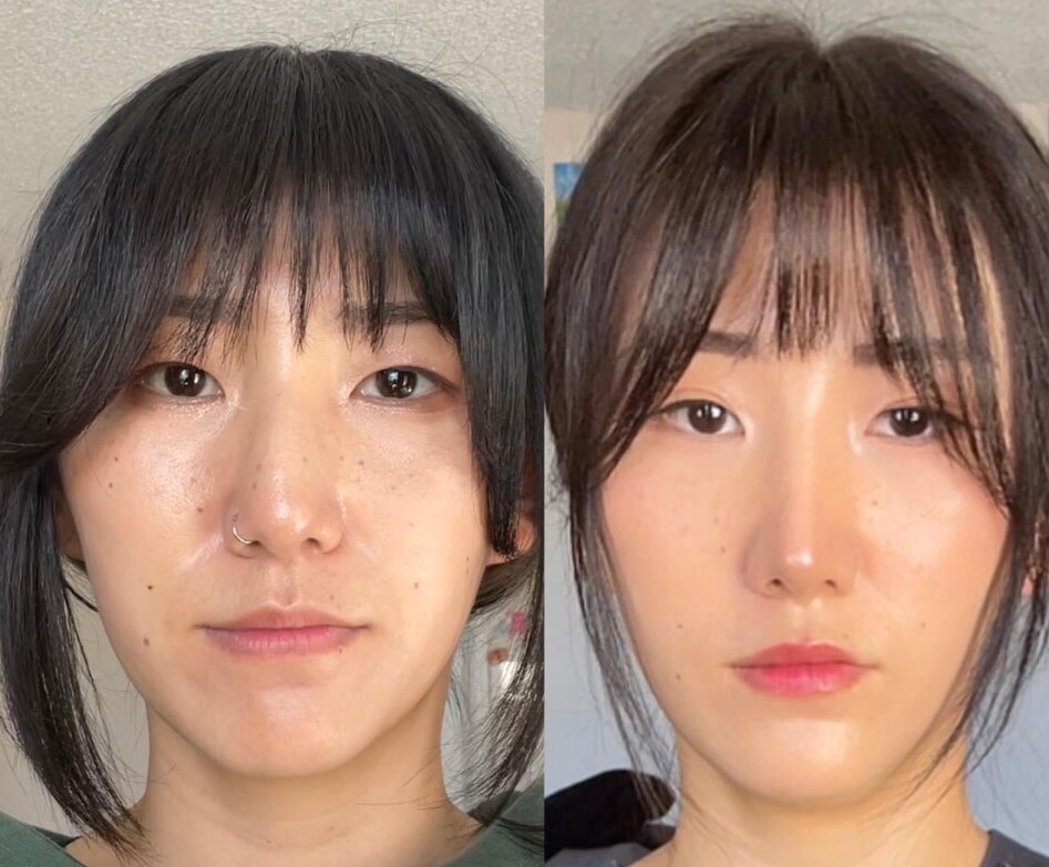 People Before And After Plastic Surgery (14 pics)