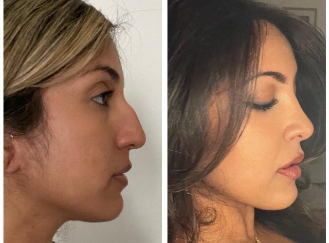 People Before And After Plastic Surgery (14 pics)